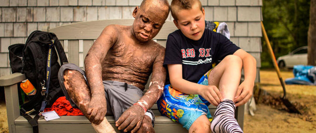 Camp Offers Haven For Young Fire Victims: They’re Not ‘The Burned Kid’ Here